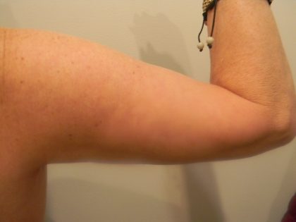 Arm Lift Before & After Patient #3668