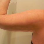 Arm Lift Before & After Patient #3668