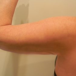 Arm Lift Before & After Patient #3668