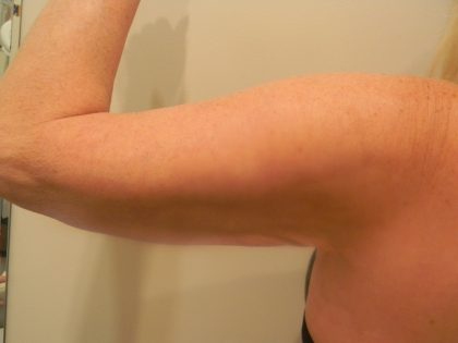 Arm Lift Before & After Patient #3668