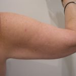 Arm Lift Before & After Patient #3668