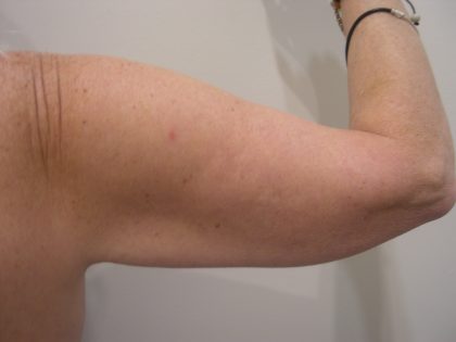 Arm Lift Before & After Patient #3668