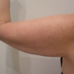 Arm Lift Before & After Patient #3668
