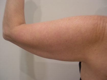 Arm Lift Before & After Patient #3668