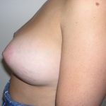 Breast Augmentation Before & After Patient #3716