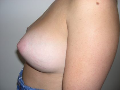 Breast Augmentation Before & After Patient #3716