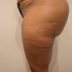Liposuction Before & After Patient #3831