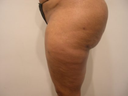 Liposuction Before & After Patient #3831