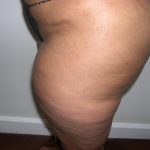 Liposuction Before & After Patient #3831