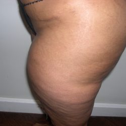 Liposuction Before & After Patient #3831