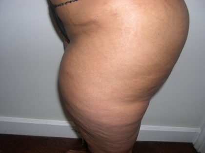 Liposuction Before & After Patient #3831