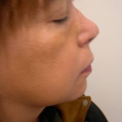 Liposuction Before & After Patient #4123