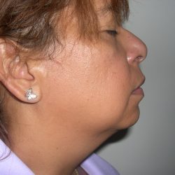 Liposuction Before & After Patient #4123