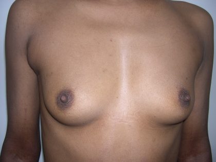 Breast Augmentation Before & After Patient #3725