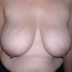 Breast Reduction Before & After Patient #4076
