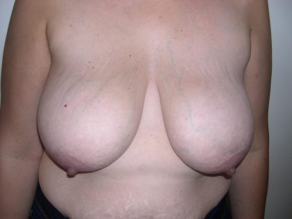 Breast Reduction Before & After Patient #4076
