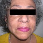 Facelift Before & After Patient #3788