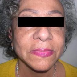 Facelift Before & After Patient #3788