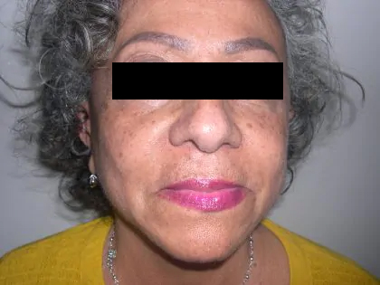 Facelift Before & After Patient #3788