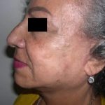 Facelift Before & After Patient #3788