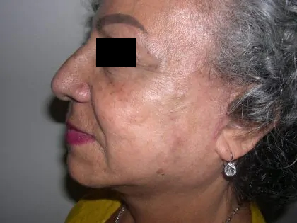 Facelift Before & After Patient #3788
