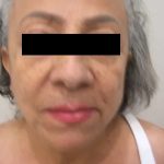 Facelift Before & After Patient #3788