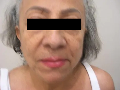 Facelift Before & After Patient #3788