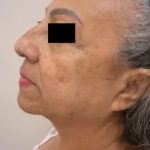 Facelift Before & After Patient #3788