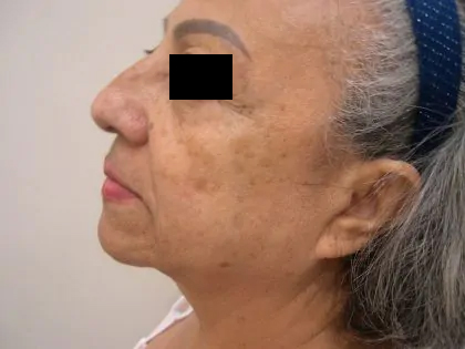 Facelift Before & After Patient #3788