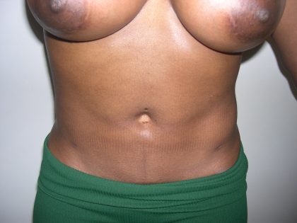 Liposuction Before & After Patient #3807
