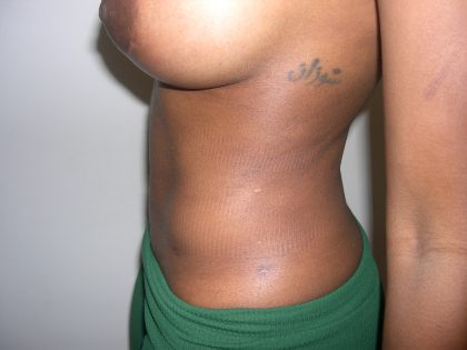 Liposuction Before & After Patient #3807