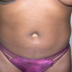 Liposuction Before & After Patient #3807