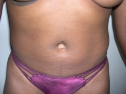 Liposuction Before & After Patient #3807