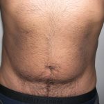 Liposuction Male Before & After Patient #3885