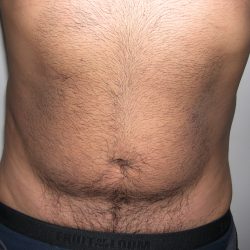 Liposuction Male Before & After Patient #3885