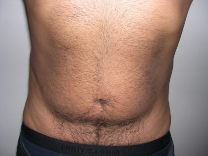 Liposuction Male Before & After Patient #3885