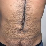 Liposuction Male Before & After Patient #3885