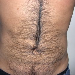 Liposuction Male Before & After Patient #3885