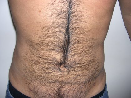 Liposuction Male Before & After Patient #3885