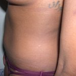 Liposuction Before & After Patient #3807