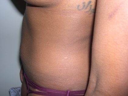 Liposuction Before & After Patient #3807