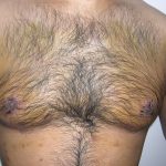 Gynecomastia Before & After Patient #3874