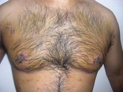 Gynecomastia Before & After Patient #3874