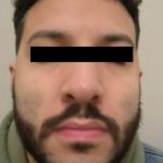 Rhinoplasty Male Before & After Patient #3904