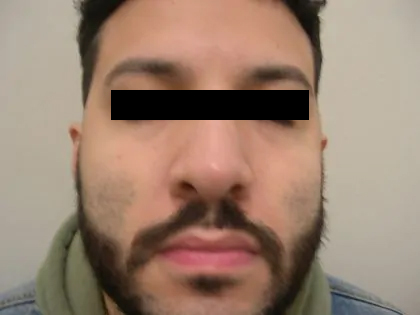 Rhinoplasty Male Before & After Patient #3904