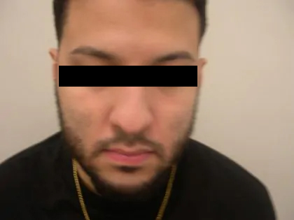 Rhinoplasty Male Before & After Patient #3904