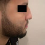 Rhinoplasty Male Before & After Patient #3904