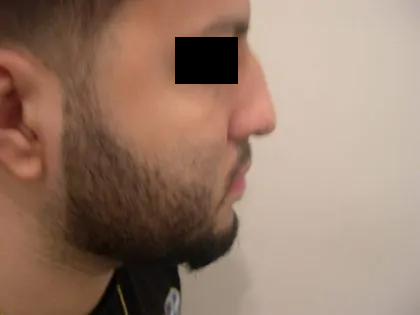 Rhinoplasty Male Before & After Patient #3904