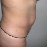 Tummy Tuck Before & After Patient #3660
