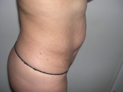 Tummy Tuck Before & After Patient #3660